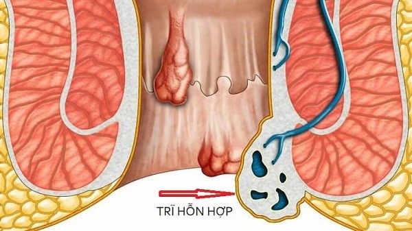 Bệnh Trĩ Có Ảnh Hưởng Đến Quan Hệ Hay Không: Giải Đáp Chi Tiết