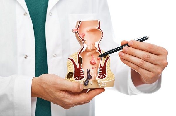 Cách Làm Teo Búi Trĩ Hiệu Quả: Hướng Dẫn Toàn Diện