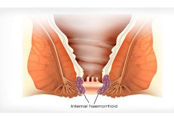 Lòi Dom Là Gì? Giải Đáp Chi Tiết Về Tình Trạng Sức Khỏe Phổ Biến